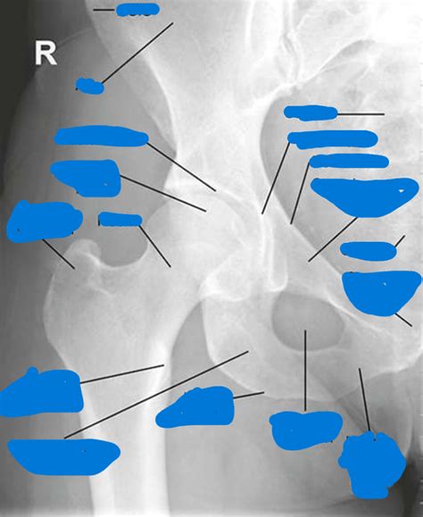 ap hip radiograph diagram quizlet