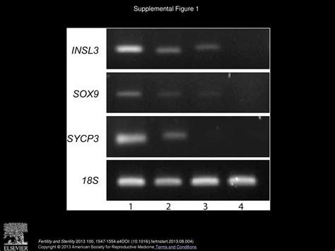 Association Of Aberrant Expression Of Sex Determining Gene Fibroblast Growth Factor 9 With