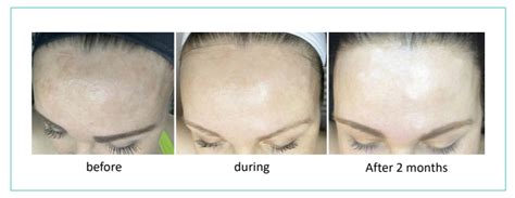 pigment correction