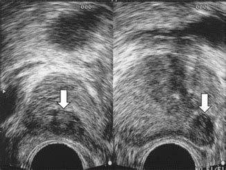 Ultrasound for Prostate Biopsy | Radiology Key