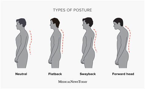Swayback Posture Symptoms