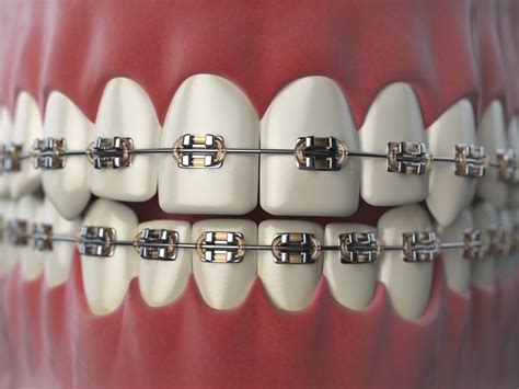 5 Types Of Dental Braces For The Millennial Girl The Sticky And Sweet