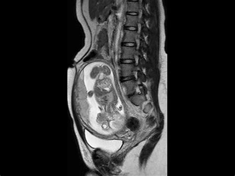 Appendicitis In Pregnant Patient Philips Mr Body Map