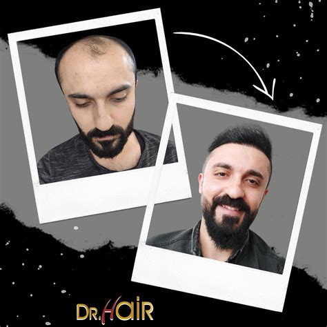 Hair Transplant Istanbul Turkey Price Drhair
