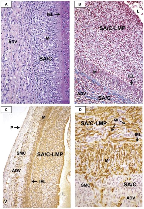 A Sa C Inflammatory Cells Extending From The Adventitia Of A Ca Has Download Scientific