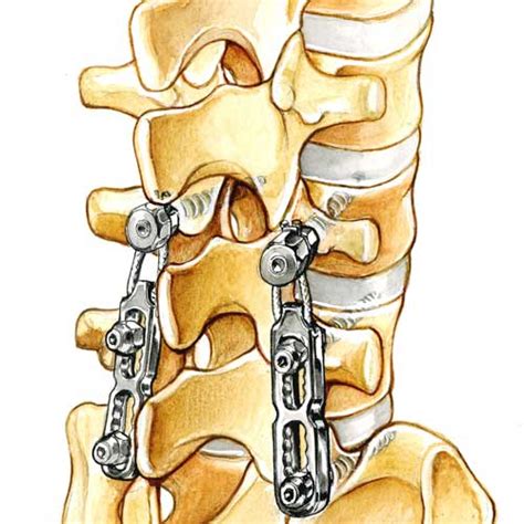 Revision Spine Surgery Cess Center Of Excellence In Spine Surgery