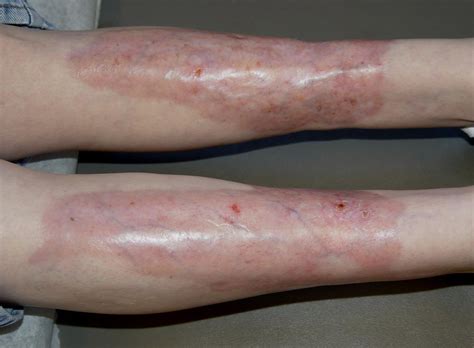 A Close Look At Necrobiosis Lipoidica