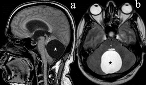 Posterior Fossa Arachnoid Cyst Sagittal T1w A And Axial T2w B Image