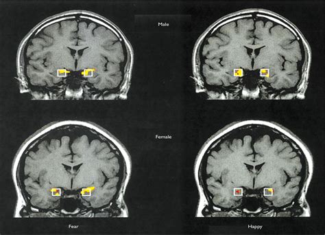 Sex Differences In Amygdala Activation During The Perception Neuroreport