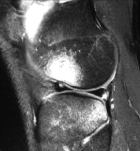 Knee Contusion Mri