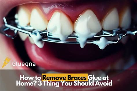 How To Remove Braces Glue At Home? 3 Things You Should Avoid - Glue QnA