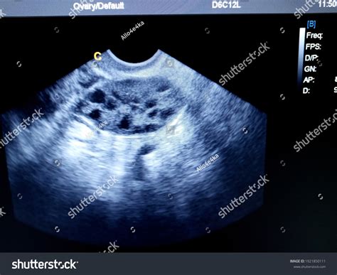 cystic ovaries images stock  vectors shutterstock