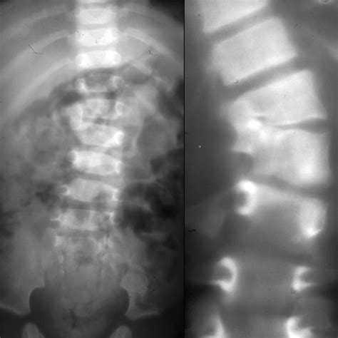 Congenital Scoliosis | Pediatric Radiology Reference Article
