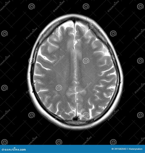 MRI Scan Of Cerebral Brain Vessels, Tomography - X-Ray Of Projections