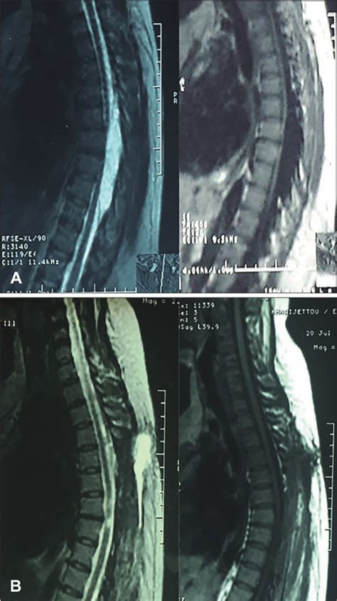 Figure From A Rare Cause Of Thoracic Spinal Cord Compression By