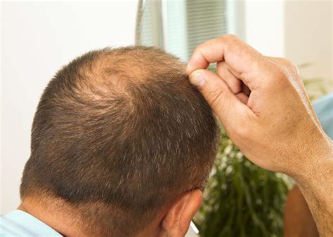 How To Deal With Hair Loss BHR Clinic Hair Transplant