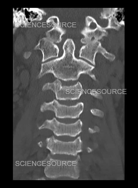 Photograph | Type III Occipital Condyle Fracture, C | Science Source Images