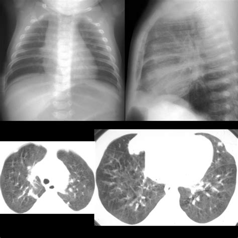 Pediatric Bronchiolitis Obliterans Pediatric Radiology Reference