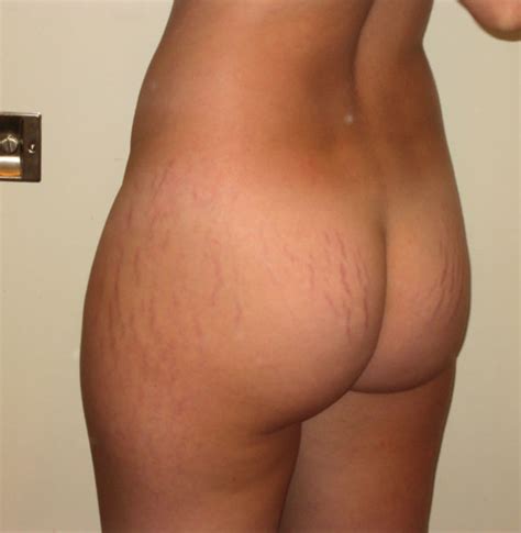 Sexy Babe Stretch Marks Sex Pictures Pass