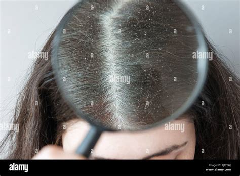 Doctor Shows Close Up Of The Parting Of Brunette Hair On The Head Covered With Dandruff View