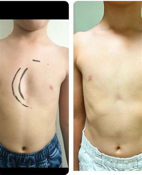 Pectus Excavatum Surgery Before After In Turkey Dr Pectus