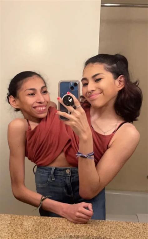 Conjoined Twin Carmen Andrade Slams Critics Obsessed With Sex Life