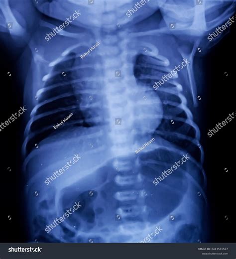 Baby Chest X Ray Pneumonia At Glenn Burgess Blog