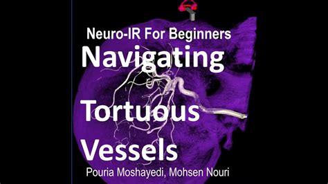 navigate tortuous vessels  neuro endovascular procedures youtube
