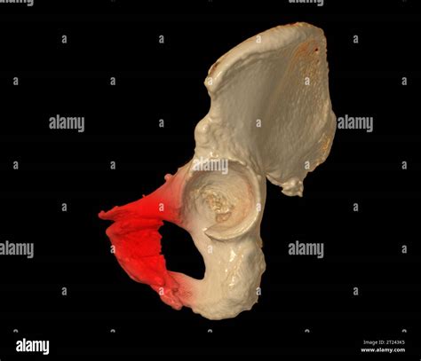 Tomograf A Computarizada De Hueso P Lvico Que Muestra Una Imagen En D