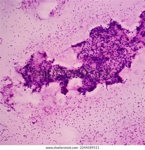 Thyroid Nodule Fna Cytology Cellular Follicular Stock Photo 2244589511 ...