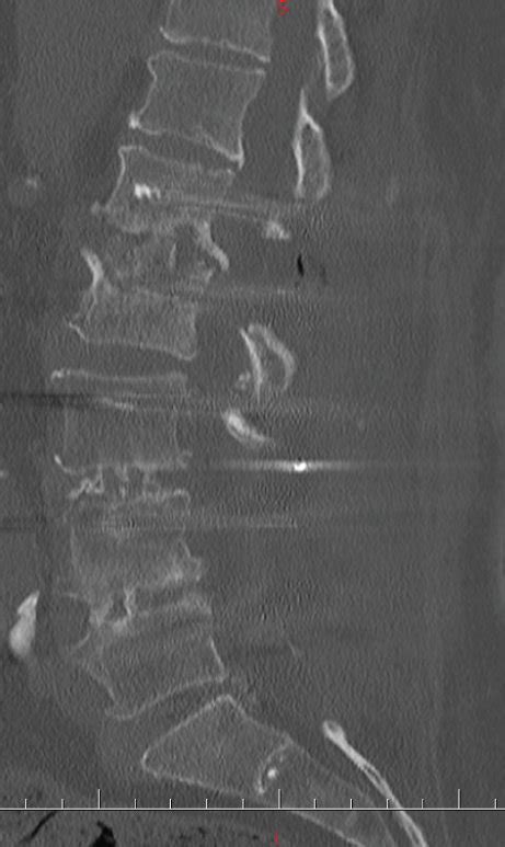 Anterior Posterior And Lateral Lumbar Radiographs Week After