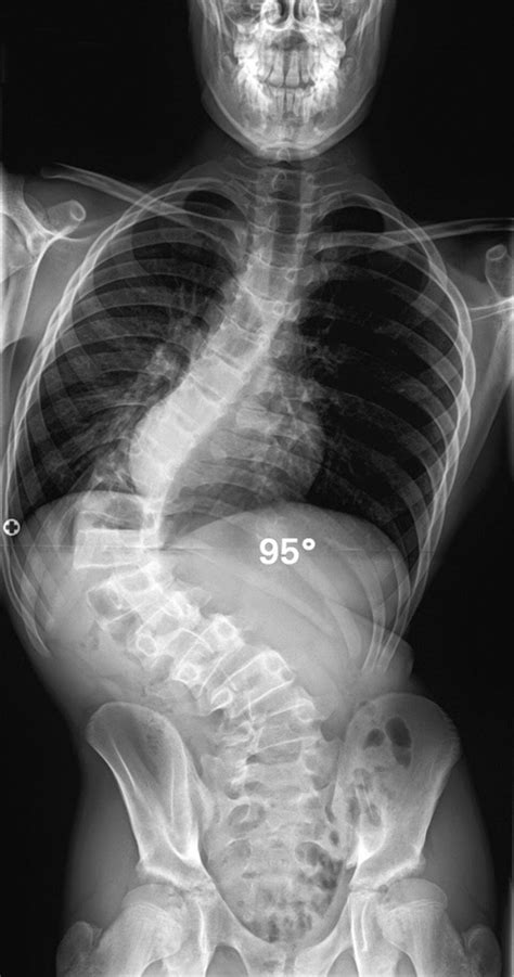 Conoce 6 síntomas de la Ataxia de Friedreich