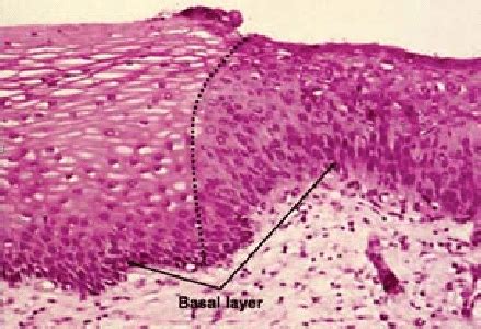 The cells on the basal layer are not perpendicular on it, diagnosed as... | Download Scientific ...