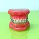 Model of dental appliance showing braces Stock Photo by Photology75