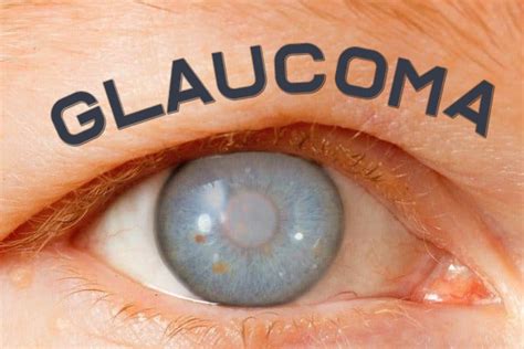 ¿qué Es El Glaucoma Clinica Hispana Harrisburg