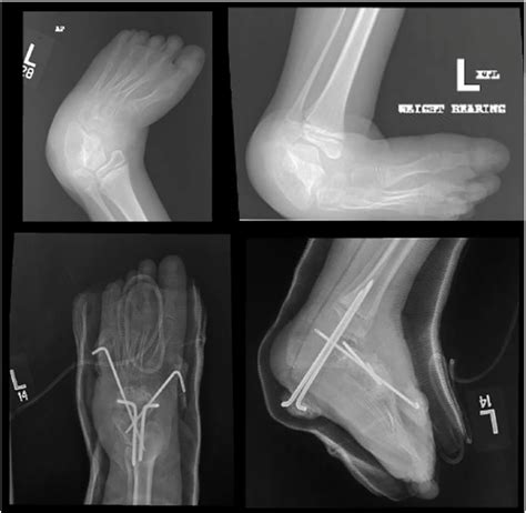 Left foot x ray shows recurrent Equinocavovarus foot deformity post... | Download Scientific Diagram