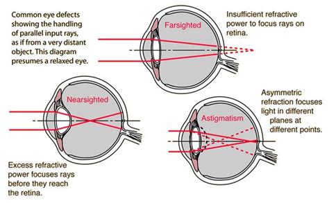 Common Eye Defects Eyes Focus Light Diagram