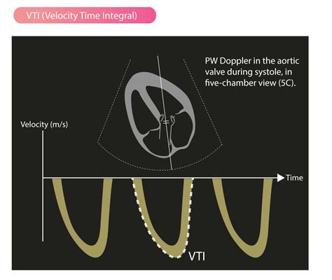 Stroke Volume Vti Velocity Time Integral Cardiac Output The