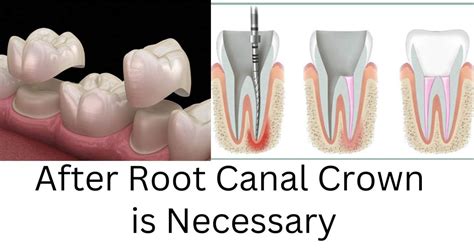 crown  root canal treatment