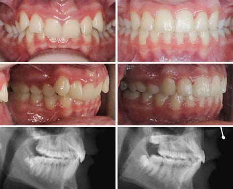 Before And After Darmitzel Orthodontics Santa Fe Nm