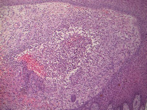 Histopathology Of Eumycotic Mycetoma Shows Suppurative Granuloma