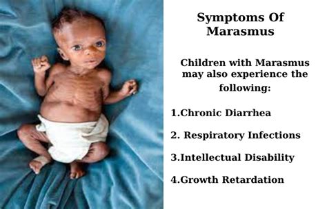 Marasmus Symptoms Causes Risks How Is It Treated