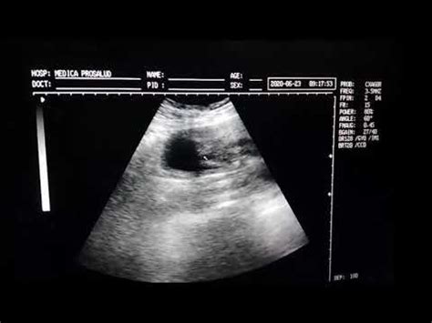 Barriga De 17 Semanas - Ecografía de 17 semanas de gestación