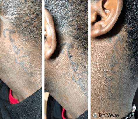 tattoo removal before and after 5