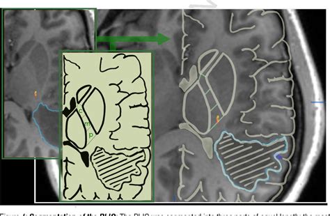 Figure From Functional Mri Vs Navigated Tms To Optimize M Seed