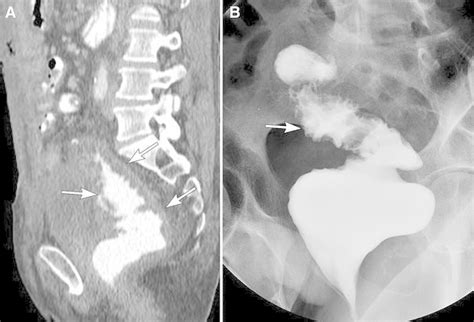 Hartmann pouchitis. A Sagittal CECT image shows irregular wall ...