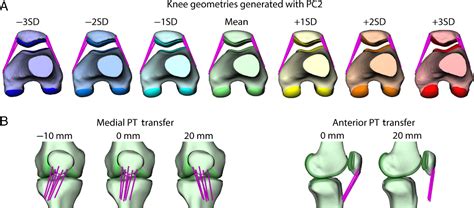 Figure 1 From Influence Of Articular Geometry And Tibial Tubercle