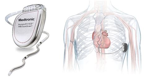Community Health Network Advancing Heart Care with Cutting-Edge ...