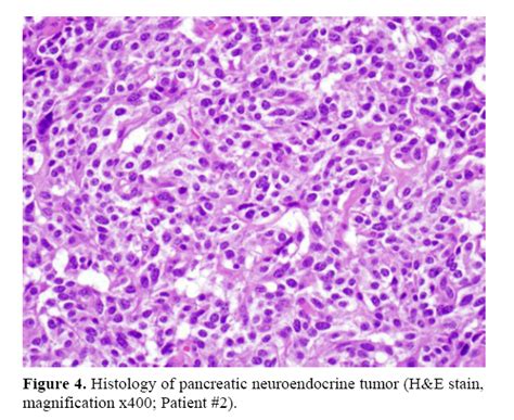 Pancreatic Neuroendocrine Tumors Among Patients With Intraductal