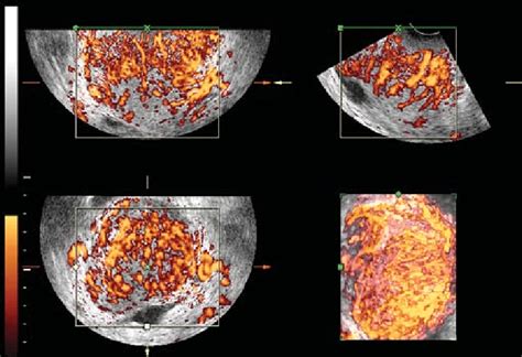 Three Dimensional Power Doppler Appearance Of Cervical Vascularity In A Download Scientific